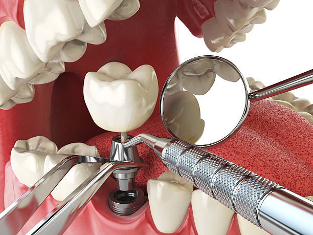 Best Emergency Dentist for Lost Fillings or Crowns in Homeland Park, SC